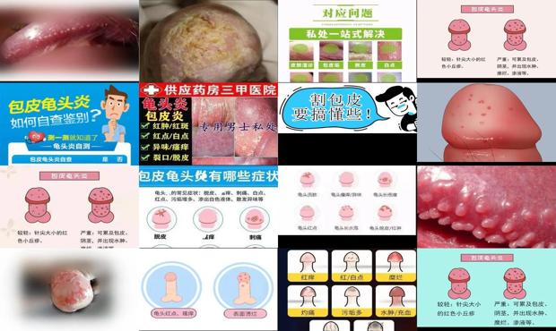汕头包皮炎症状对照图片