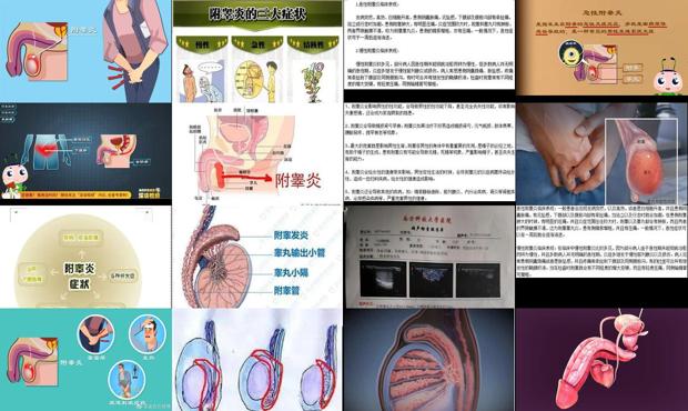 附睾炎睾丸炎怎么治疗 - 汕头附睾炎症状