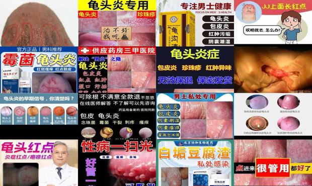 汕头白色念珠菌疫苗 - 汕头白色念珠菌龟头炎症状