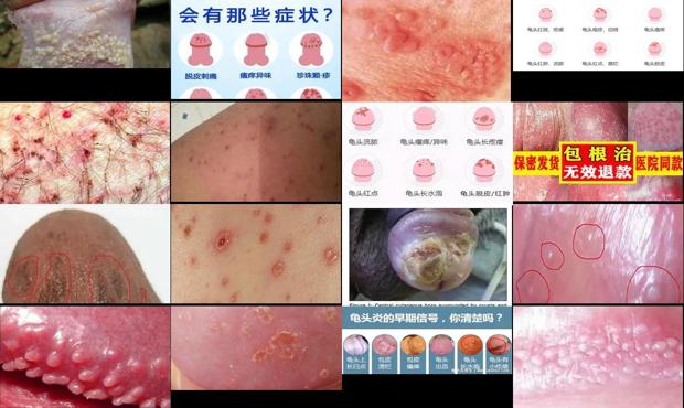 鬼头炎症抹什么药膏效果好 - 汕头鬼头炎症