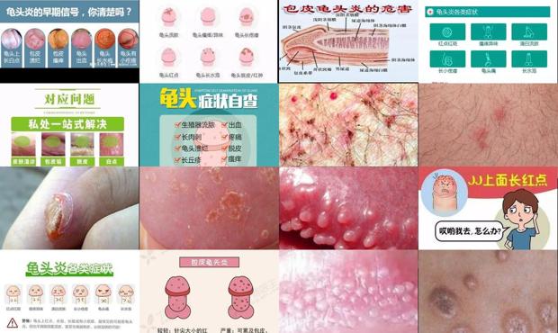 汕头龟头炎症状