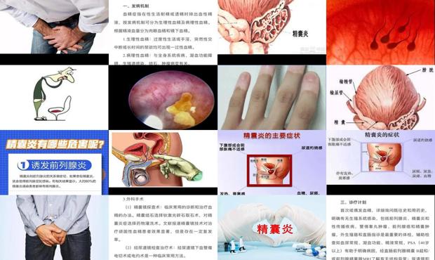 精囊炎怎么办? - 汕头精囊炎症状表现有哪些