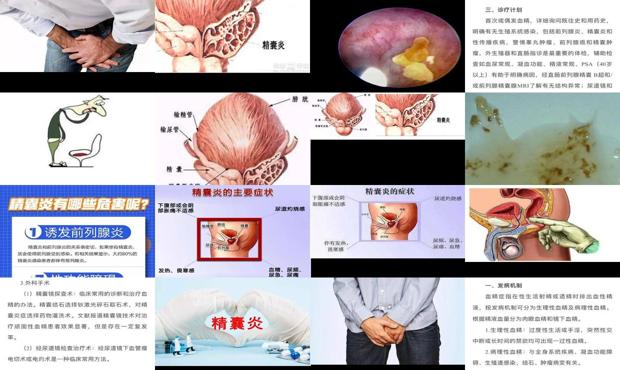 精囊炎最初症状 - 汕头精囊炎症状