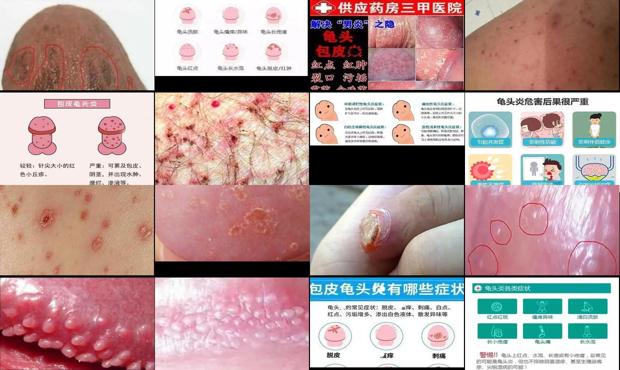 汕头男生怎么样 - 汕头男人龟头炎症状