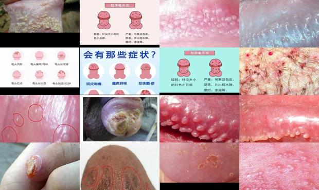 鬼头炎症抹什么药膏效果好 - 汕头鬼头炎症图片