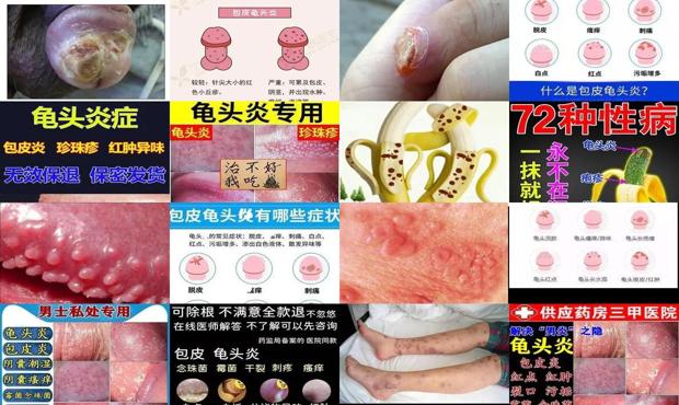 霉菌性龟炎用什么药 - 汕头霉菌性龟头炎症状表现