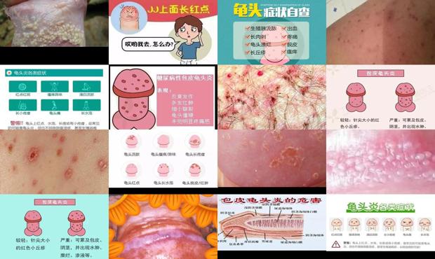 汕头男科性疾病 - 汕头龟头炎症状对照图片