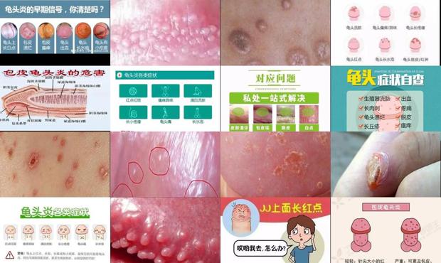 鬼头炎症用什么药好百度知道 - 汕头鬼头炎症状