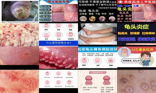 汕头大学 - 汕头霉菌性龟头炎症状