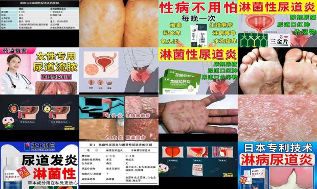 淋球菌尿道感染怎么治疗 - 汕头淋球菌尿道炎症状