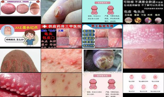 念珠菌性包皮炎 - 汕头念珠菌性龟头炎症图片