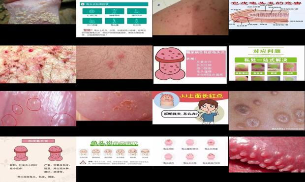 汕头男科性疾病 - 汕头龟头炎症状表现