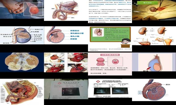 汕头睾丸炎症治疗医院 - 汕头睾丸炎症
