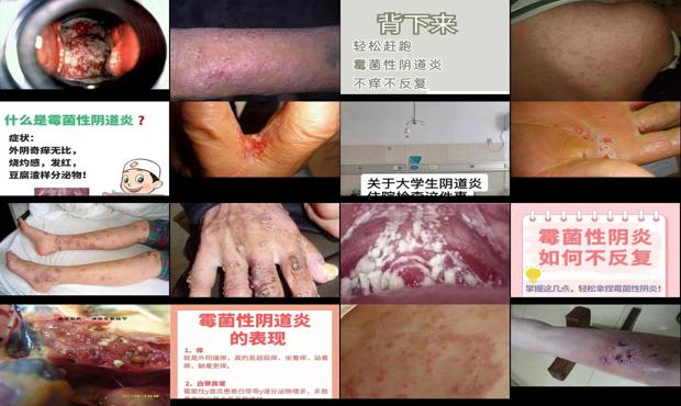霉菌炎怎么治疗? - 汕头霉菌炎症状图片大全