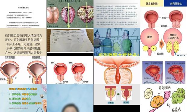 前列腺肥大能治愈吗视频 - 汕头前列腺肥大是什么原因引起