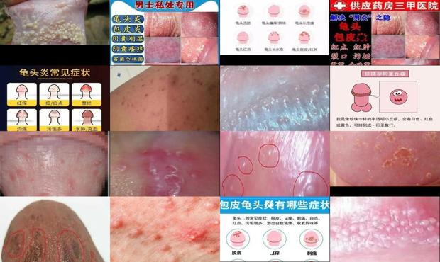 包皮炎用什么药最有效 - 汕头包皮炎龟头炎症状