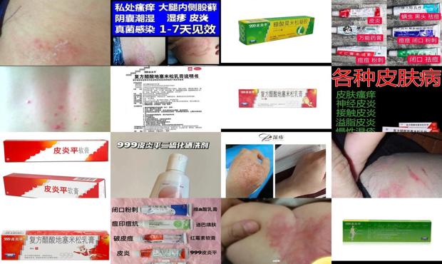 皮炎平治头屑吗 - 汕头皮炎平可以治疗龟头炎症吗