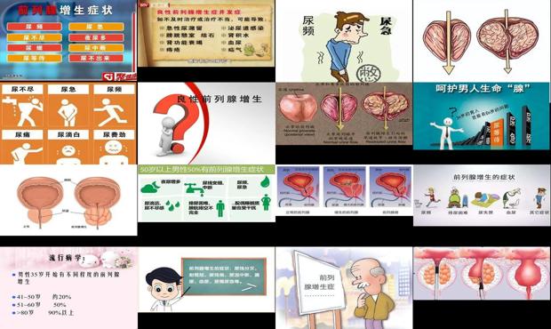 前列腺增生专家门诊 - 汕头前列腺增生的症状