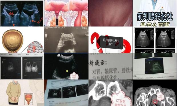前列腺钙化灶视频 - 汕头前列腺钙化是什么意思