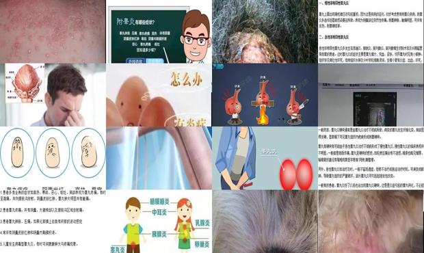 睾丸炎的前兆 - 汕头睾丸炎症状的图片图库