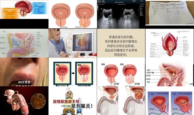 前列腺增大治疗的方法 - 汕头前列腺增大