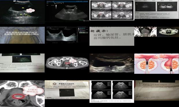 汕头前列腺钙化治疗医院 - 汕头前列腺钙化灶