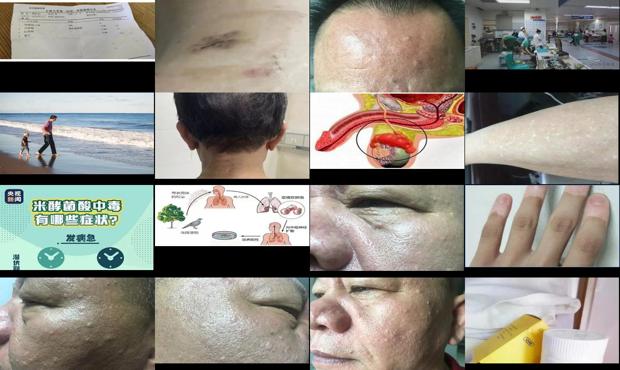 遵义百草园在哪里 - 汕头前腺炎症状