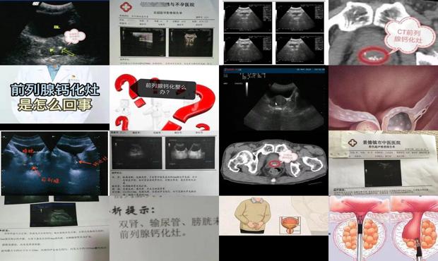 前列腺 钙化 - 汕头前列腺钙化灶是什么意思