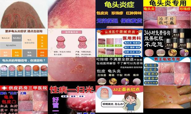 白色念珠菌感染 - 汕头白念珠菌性龟头炎症状