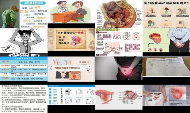 汕头前列腺炎的治疗医院 - 汕头前列腺炎的表现