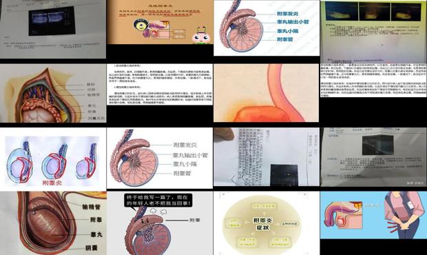 附睾丸炎症如何治疗 - 汕头附睾炎症