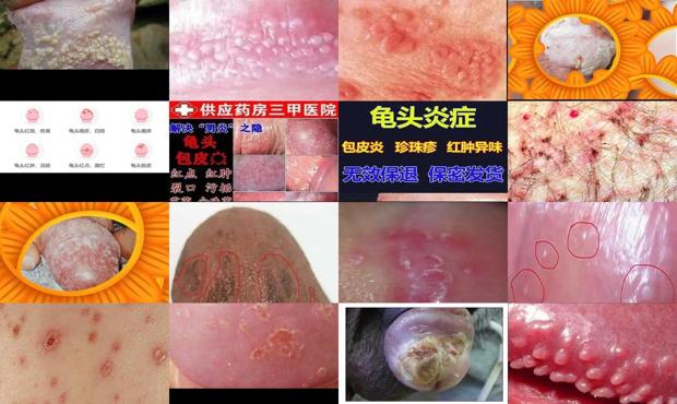汕头男性正规医院 - 汕头男性龟头炎症