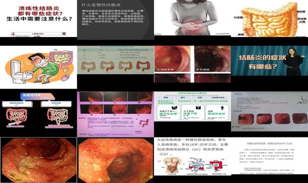 请问一下结肠炎是怎样 - 汕头结肠炎症状