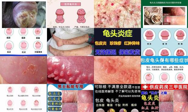 龟霉菌病 - 汕头霉菌龟头炎症状