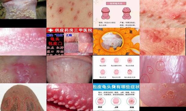汕头中心医院割包皮多少钱 - 汕头包皮龟头炎症