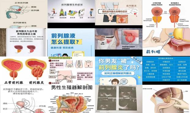 男性前列腺医院 - 汕头前列腺怎么判断