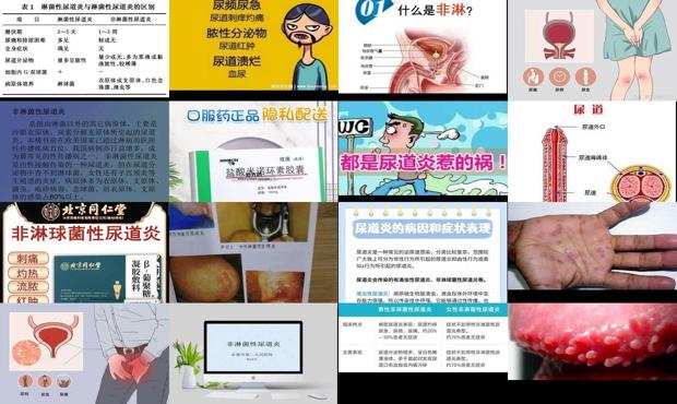 男性非淋的治疗 - 汕头男人非淋性尿道炎症状