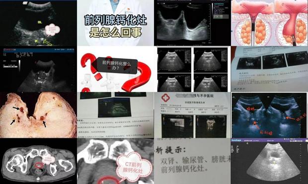我体检前列腺钙化灶,怎么治疗? - 汕头前列腺钙化灶什么意思