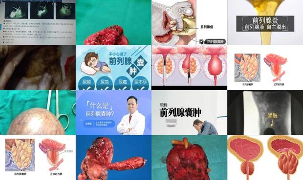 汕头前列腺囊肿手术医院 - 汕头前列腺囊肿是怎么回事