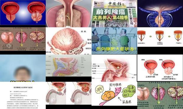 前列腺肥大的症状治疗要需要多少钱 - 汕头前列腺肥大的