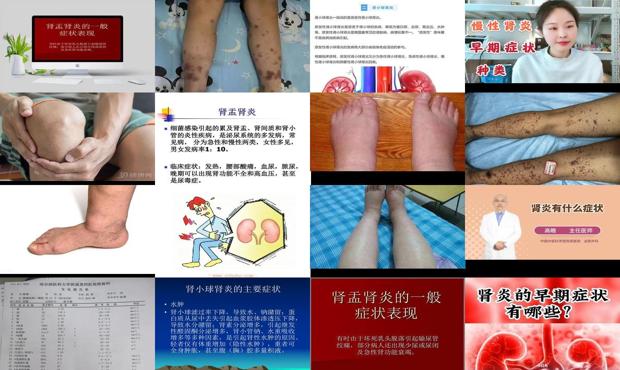 轻微肾炎的10个症状 - 汕头肾炎症状
