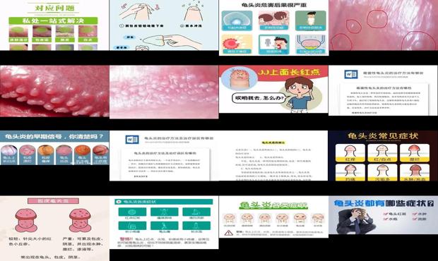 汕头男科性疾病 - 汕头龟头炎症状与治疗方法