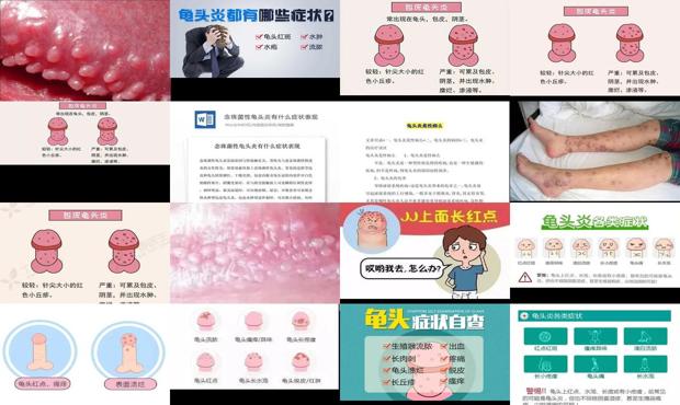 汕头男科性疾病 - 汕头龟头炎症状表现有哪些