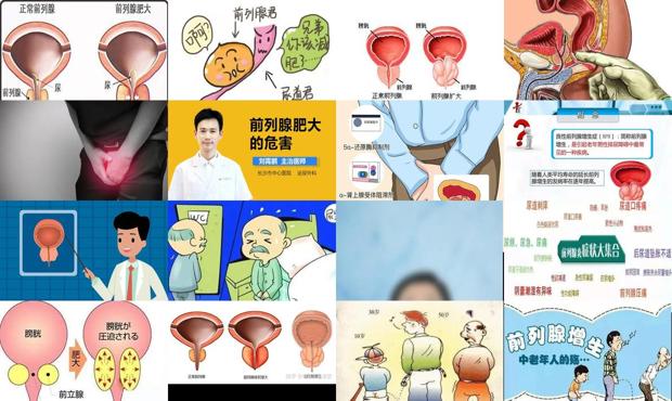 前列腺肥大能自愈吗 - 汕头前列腺肥大有什么危害