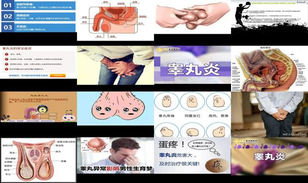 男性睾丸炎是怎么回事 - 汕头男性睾丸炎症状