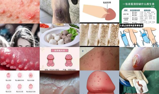 包头包皮炎 - 汕头包皮炎症状对照图片图