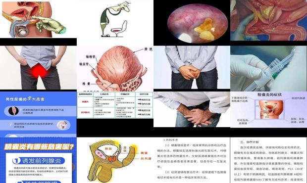 汕头精囊炎症状医院 - 汕头精囊炎症状的表现