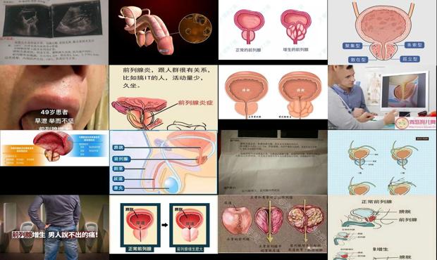 汕头前列腺增大中医专家 - 汕头前列腺增大是什么意思