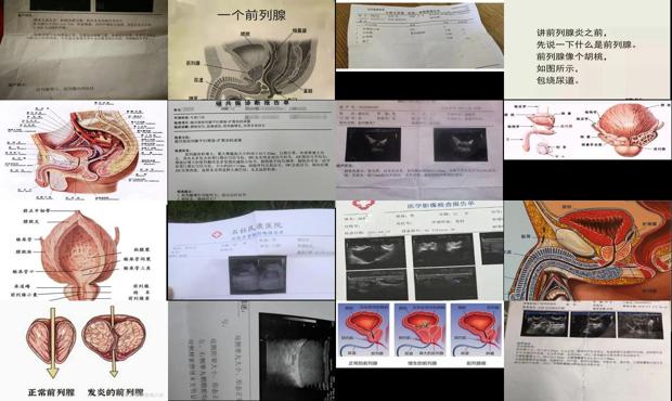 前列腺稍大是什么意思? - 汕头前列腺稍大是什么意思
