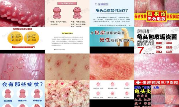 汕头最好的男科医院哪好 去哪 - 汕头龟头下炎症